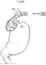 Fig. 43 - Apparatus and method for treating obesity