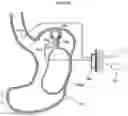 Fig. 60 - Apparatus and method for treating obesity