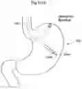 Fig. 71 - Apparatus and method for treating obesity