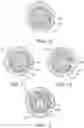 Fig. 06 - Speed differential device of double overrunning clutch device