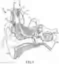 Fig. 02 - Hybrid electrically- and mechanically-stimulating cochlear implant