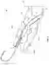 Fig. 03 - Fishhook remover