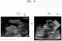 Fig. 17 - Method and apparatus for displaying ultrasound image providing orientation of fetus and computer program product