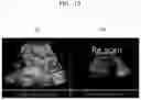 Fig. 21 - Method and apparatus for displaying ultrasound image providing orientation of fetus and computer program product