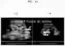Fig. 22 - Method and apparatus for displaying ultrasound image providing orientation of fetus and computer program product