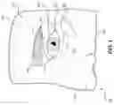 Fig. 02 - Lateral cathotomy and cantholysis simulation device