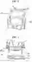Fig. 03 - External fixator having rotatable bone reduction frame