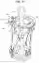 Fig. 10 - External fixator having rotatable bone reduction frame