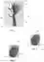 Fig. 03 - Repositionable Removable Fishing Hook Trailer Device