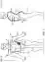 Fig. 02 - System for detecting stent slippage