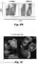Fig. 27 - Methods of treating Danon disease