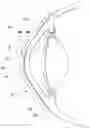 Fig. 01 - Tear shaping for refractive correction