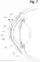 Fig. 04 - Tear shaping for refractive correction
