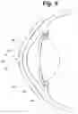 Fig. 06 - Tear shaping for refractive correction