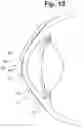 Fig. 07 - Tear shaping for refractive correction