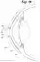 Fig. 08 - Tear shaping for refractive correction
