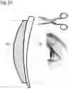 Fig. 09 - Optical element for converting a single-vision lens to a progressive lens