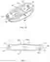 Fig. 06 - Intersomatic prosthesis with lateral introduction
