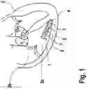Fig. 02 - AV synchrony with a ventricular leadless pacemaker using varying ventricular measures