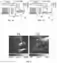 Fig. 02 - Method of photoacoustic imaging intraocular tumors including back-projection reconstruction to measure heterogeneity
