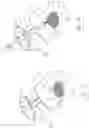 Fig. 35 - INFLATABLE PNEUMOPERITONEUM DEVICE