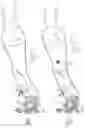 Fig. 50 - INFLATABLE PNEUMOPERITONEUM DEVICE