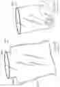 Fig. 52 - INFLATABLE PNEUMOPERITONEUM DEVICE
