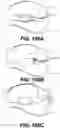 Fig. 83 - INFLATABLE PNEUMOPERITONEUM DEVICE