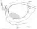 Fig. 95 - INFLATABLE PNEUMOPERITONEUM DEVICE
