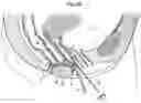 Fig. 03 - Surgical instrument