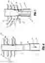 Fig. 06 - TUBULAR TISSUE REMOVAL PROCEDURE
