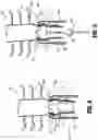 Fig. 07 - TUBULAR TISSUE REMOVAL PROCEDURE