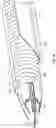 Fig. 11 - Excisional devices and methods