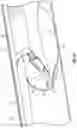 Fig. 35 - Excisional devices and methods