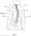 Fig. 02 - External adjustment device for distraction device