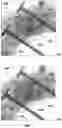 Fig. 08 - Apparatus and method for minimally invasive osteosynthesis of sacroiliac luxations/fractures