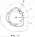 Fig. 16 - Method and apparatus for treating bone fractures, and/or for fortifying and/or augmenting bone, including the provision and use of composite implants, and novel composite structures which may be used for medical and non-medical applications