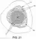 Fig. 20 - Method and apparatus for treating bone fractures, and/or for fortifying and/or augmenting bone, including the provision and use of composite implants, and novel composite structures which may be used for medical and non-medical applications