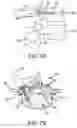 Fig. 09 - Image-guided minimal-step placement of screw into bone