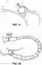 Fig. 02 - Releasable attachment device for coupling to medical devices and related systems and methods