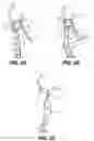 Fig. 04 - Releasable attachment device for coupling to medical devices and related systems and methods