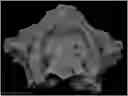 Fig. 01 - Three-dimensional printed bone supported sinus guide for edentulous maxillary arch