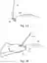 Fig. 06 - Device for the delivery of a prosthetic implant and method of use thereof