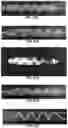 Fig. 32 - Airway stents