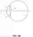 Fig. 07 - Systems and methods for spectacle independence using refractive index writing with an intraocular lens
