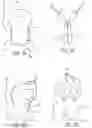 Fig. 05 - METHOD OF IMPLANTING VALVE PROSTHESIS HAVING ATRIAL ANCHORING