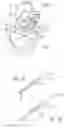 Fig. 06 - METHOD OF IMPLANTING VALVE PROSTHESIS HAVING ATRIAL ANCHORING