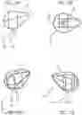 Fig. 14 - METHOD OF IMPLANTING VALVE PROSTHESIS HAVING ATRIAL ANCHORING
