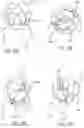 Fig. 20 - METHOD OF IMPLANTING VALVE PROSTHESIS HAVING ATRIAL ANCHORING