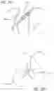 Fig. 22 - METHOD OF IMPLANTING VALVE PROSTHESIS HAVING ATRIAL ANCHORING